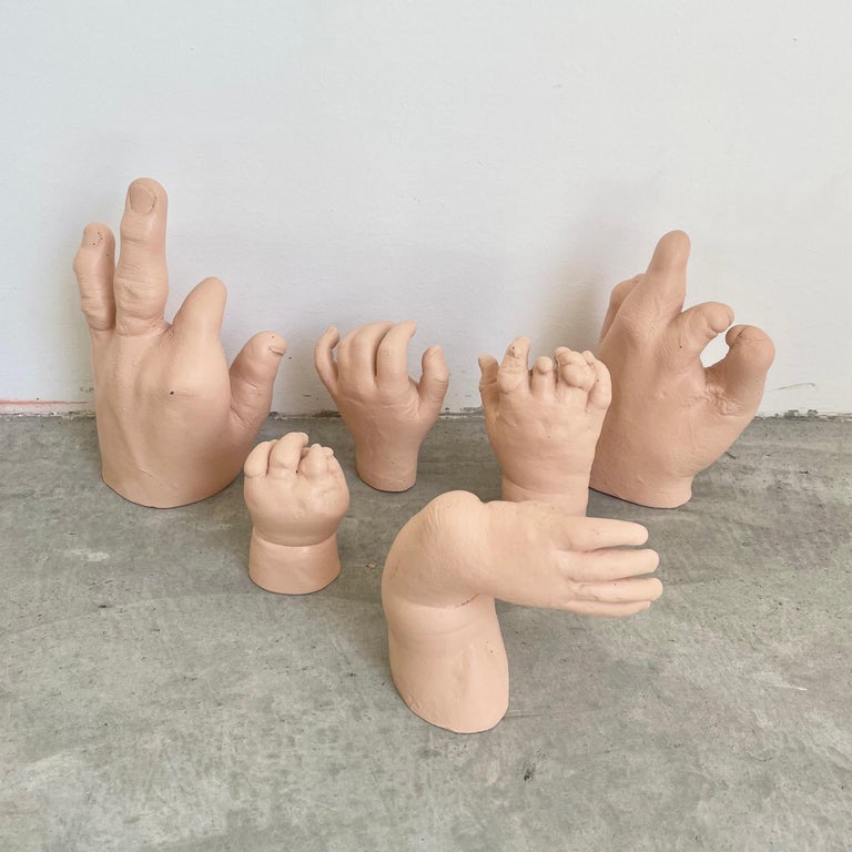 Six Anatomical Castings of Deformed Hands, 1960s USA